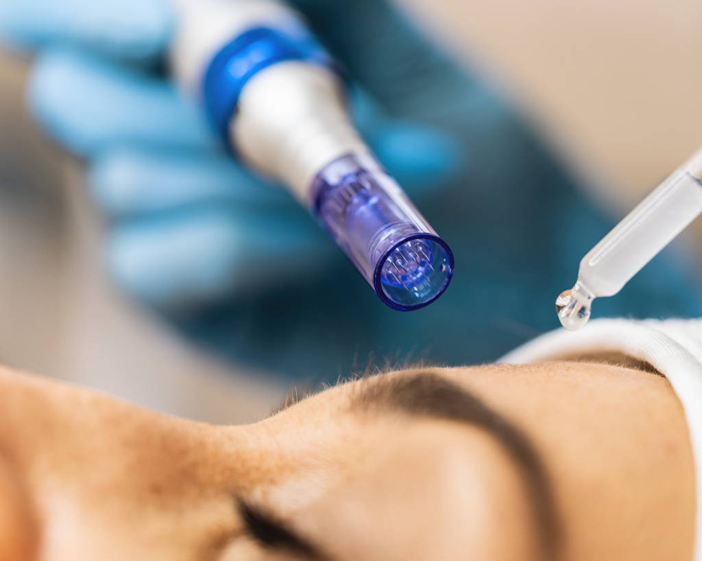 closeup of microneedling; microdermabrasion vs microneedling