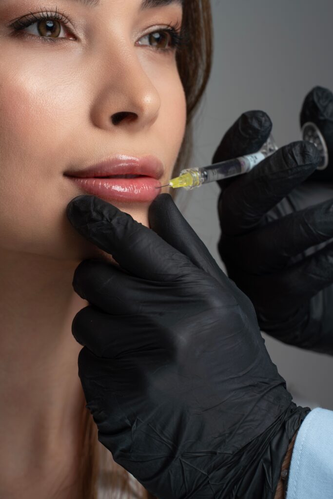 lip fillers before and after